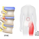 How To Get Sciatica Pain Relief