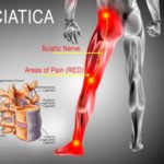 How To Sit Comfortably With Sciatica